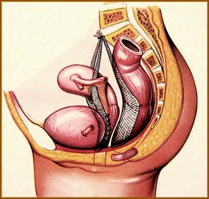 chirurgie descente d'organe